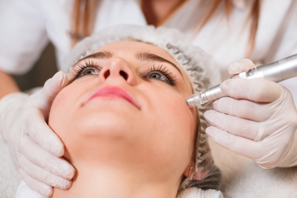 Microneedling